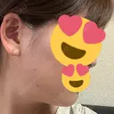 脂肪溶解注射（顔） 聖心美容クリニック 広島院 DAY 23 サムネイル用