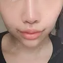 人中短縮 / 口角挙上 清潭女神美容外科 DAY 8 サムネイル用