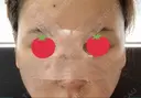 鼻尖形成（切開） / 鼻中隔延長（切開） / 軟骨移植 / 骨切幅寄せ / ワシ鼻修正・ハンプ切除 / 眉間プロテーゼ グロービー美容整形外科 DAY 1 サムネイル用