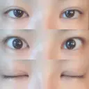 二重切開 / 目頭切開 / 眼瞼下垂（切開） / その他（目元） / 上まぶたの脂肪取り レアート整形外科 AFTER サムネイル用