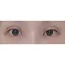 二重切開 / 目頭切開 / 上まぶたの脂肪取り / 蒙古ひだ形成 FROM B整形外科 (旧バウム整形外科) DAY 27 サムネイル用