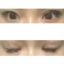 眼瞼下垂（切開） ピュア形成外科医院 AFTER サムネイル用