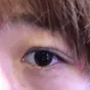 二重埋没 城本クリニック 姫路院 DAY 0 サムネイル用