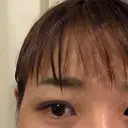 二重埋没 城本クリニック 姫路院 AFTER サムネイル用