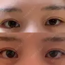 ボトックス（タレ目） 新宿ラクル美容外科クリニック 新宿院 AFTER サムネイル用