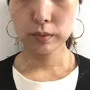 脂肪溶解注射（顔） ビクアスクリニック DAY 25 サムネイル用