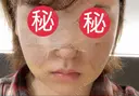 鼻尖形成（切開） / 鼻中隔延長（切開） / 軟骨移植 / 骨切幅寄せ / ワシ鼻修正・ハンプ切除 / 眉間プロテーゼ グロービー美容整形外科 DAY 6 サムネイル用