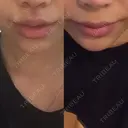 人中短縮 / 口角挙上 清潭女神美容外科 DAY 13 サムネイル用