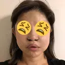 人中短縮 / 鼻翼挙上 大阪TAクリニック DAY 217 サムネイル用