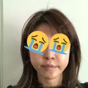 人中短縮 / 鼻翼挙上 大阪TAクリニック AFTER サムネイル用