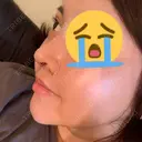 隆鼻術 / 鼻尖形成（切開） / 鼻孔縁挙上 / 鼻尖縮小 加美（GAMI）整形外科 DAY 8 サムネイル用