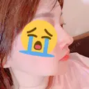 隆鼻術 / 鼻尖形成（切開） / 鼻孔縁挙上 / 鼻尖縮小 加美（GAMI）整形外科 AFTER サムネイル用