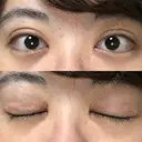 二重切開 / 目頭切開 / ほくろ・いぼ切除（肌） / 上まぶたたるみ取り / 上まぶたの脂肪取り 東京美容外科 銀座院 DAY 108 サムネイル用