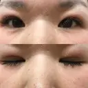 二重埋没 メディカルビューティセンター AFTER サムネイル用