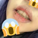 口唇縮小術 / PRP皮膚再生療法 品川スキンクリニック福岡院 DAY 6 サムネイル用