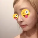 骨切り（あご） / 骨削り（エラ） / 骨削り（頬） / 脂肪吸引（顔） / ヒアルロン酸溶解 View美容整形外科 DAY 41 サムネイル用