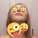 骨切り（あご） / 骨削り（エラ） / 骨削り（頬） / 脂肪吸引（顔） / ヒアルロン酸溶解 View美容整形外科 DAY 41 サムネイル用