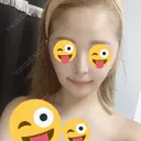 骨切り（あご） / 骨削り（エラ） / 骨削り（頬） / 脂肪吸引（顔） / ヒアルロン酸溶解 View美容整形外科 DAY 41 サムネイル用