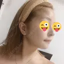 骨切り（あご） / 骨削り（エラ） / 骨削り（頬） / 脂肪吸引（顔） / ヒアルロン酸溶解 View美容整形外科 DAY 41 サムネイル用