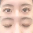 二重埋没 共立美容外科 新宿本院 DAY 11 サムネイル用