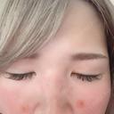シミ取りレーザー 芦屋美容クリニック 芦屋院 AFTER サムネイル用