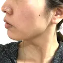 脂肪溶解注射（顔） ビクアスクリニック DAY 32 サムネイル用