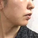 脂肪溶解注射（顔） ビクアスクリニック DAY 32 サムネイル用