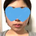 脂肪吸引（顔） GRACIA clinic 【グラシアクリニック】 AFTER サムネイル用