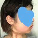 脂肪吸引（顔） GRACIA clinic 【グラシアクリニック】 DAY 92 サムネイル用