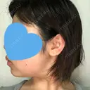 脂肪吸引（顔） GRACIA clinic 【グラシアクリニック】 DAY 92 サムネイル用