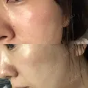 イオン導入 / 美肌レーザー / フォトRF / ニキビ治療 サッポロファクトリー 皮膚科・スキンケアクリニック DAY 7 サムネイル用