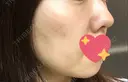 イオン導入 / 美肌レーザー / フォトRF / ニキビ治療 サッポロファクトリー 皮膚科・スキンケアクリニック DAY 43 サムネイル用