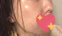 イオン導入 / 美肌レーザー / フォトRF / ニキビ治療 サッポロファクトリー 皮膚科・スキンケアクリニック AFTER サムネイル用