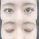 二重埋没 共立美容外科 新宿本院 AFTER サムネイル用