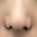 小鼻縮小（切開） キップン整形外科 DAY 2 サムネイル用