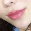 人中短縮 / 口唇縮小術 / 口角挙上 HB整形外科 DAY 167 サムネイル用