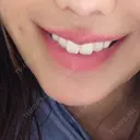 人中短縮 / 口唇縮小術 / 口角挙上 HB整形外科 DAY 167 サムネイル用