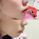 口唇縮小術 / PRP皮膚再生療法 品川スキンクリニック福岡院 AFTER サムネイル用