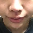 人中短縮 / 口角挙上 清潭女神美容外科 DAY 22 サムネイル用