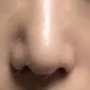 小鼻縮小（切開） キップン整形外科 DAY 3 サムネイル用