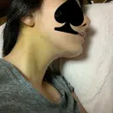 小鼻縮小（切開） / 軟骨移植 / 斜鼻修正 キップン整形外科 DAY 10 サムネイル用