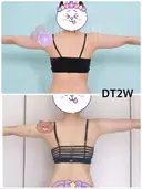 脂肪溶解注射（二の腕） / ボトックス（肩） / その他（ボディ） THE SKINNY CLINIC（ザ・スキニークリニック） DAY 14 サムネイル用