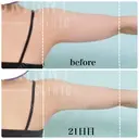 脂肪溶解注射（二の腕） / ボトックス（肩） / その他（ボディ） THE SKINNY CLINIC（ザ・スキニークリニック） DAY 22 サムネイル用