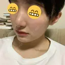 小鼻縮小（切開） / 軟骨移植 / 斜鼻修正 キップン整形外科 DAY 10 サムネイル用