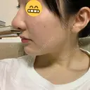 小鼻縮小（切開） / 軟骨移植 / 斜鼻修正 キップン整形外科 DAY 10 サムネイル用