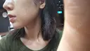 脂肪吸引（顔） THE CLINIC（ザ・クリニック） 東京院 DAY 79 サムネイル用
