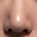 小鼻縮小（切開） キップン整形外科 DAY 6 サムネイル用