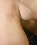 クマ治療 / 額を丸く / 脂肪吸引（脚） / レディエッセ注入（鼻） THE CLINIC（ザ・クリニック） 東京院 DAY 5 サムネイル用