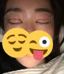 二重埋没 / 眼瞼下垂（切開） / 目尻切開 / 蒙古ひだ形成 / タレ目形成・グラマラスライン（切開） POP美容整形クリニック DAY 0 サムネイル用