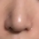 小鼻縮小（切開） キップン整形外科 DAY 7 サムネイル用